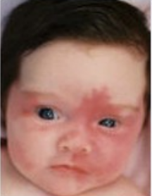 Sturge-Weber syndrome