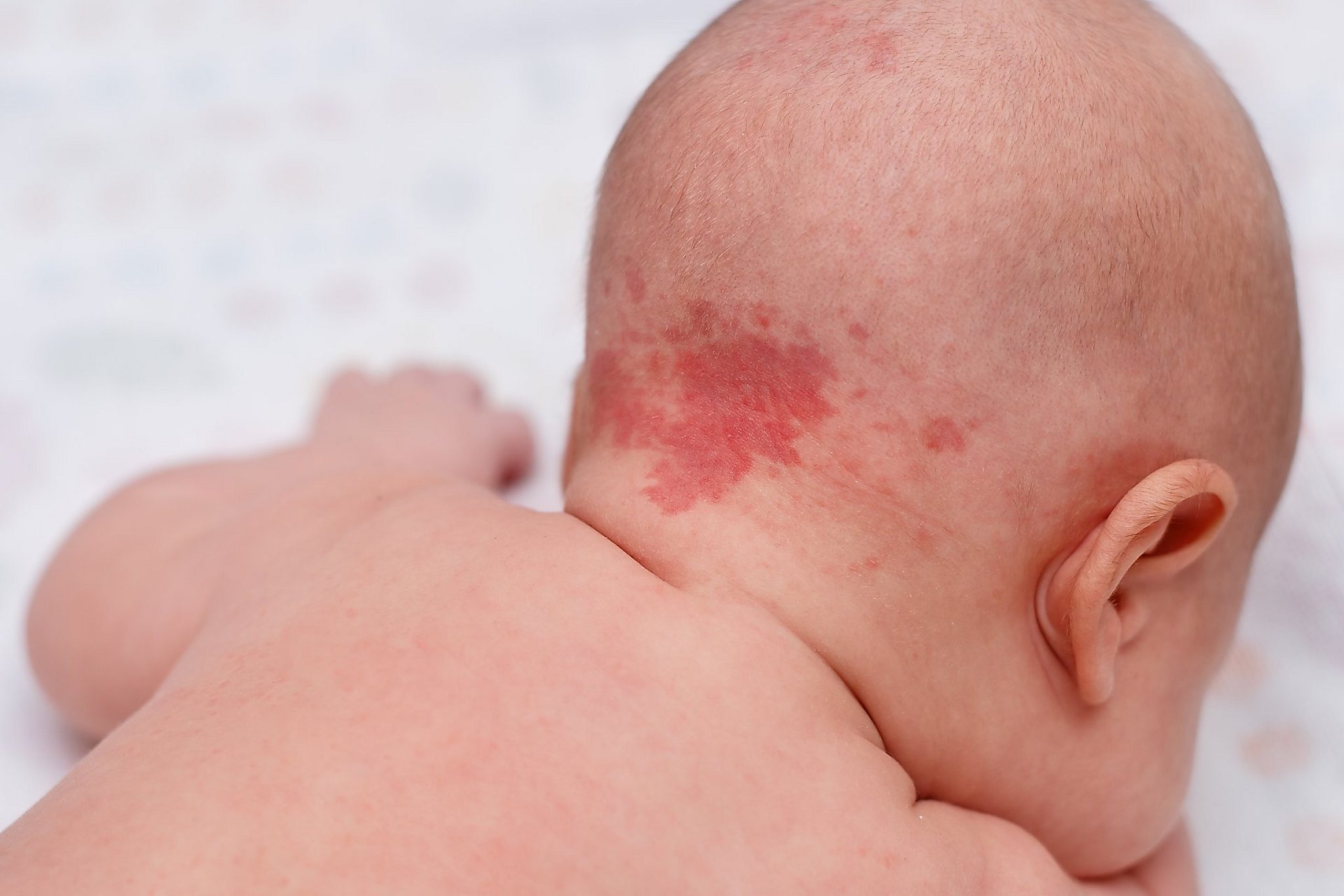 Névus simplex na zátylku