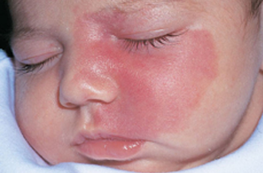 Névus flammeus na tvári