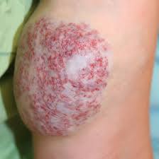 Kongenitálny hemangióm