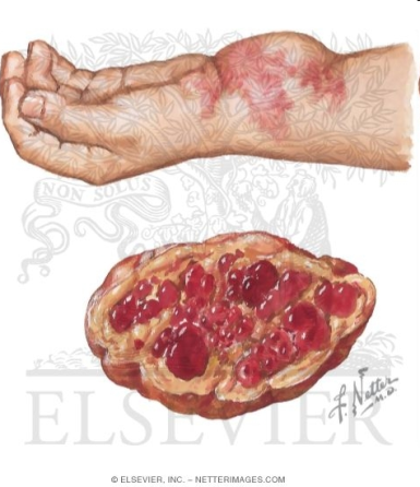 Ilustrácia hemangiómu