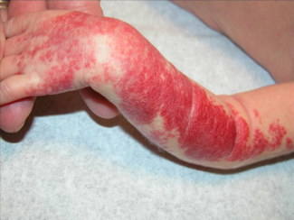 Segmentárny hemangióm