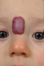 Lokalizovaný hemangióm