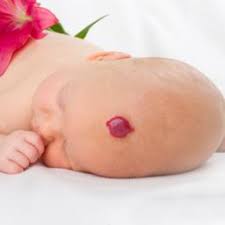 Infantilný hemangióm