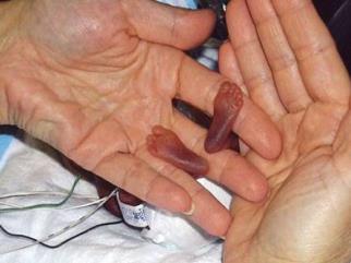 Rizikové faktory – predčasný pôrod